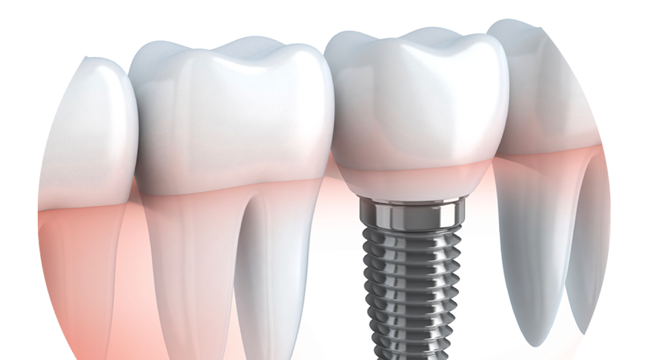 Implantátumok