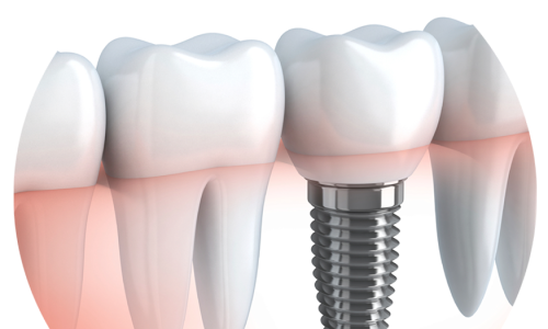 Implantátumok